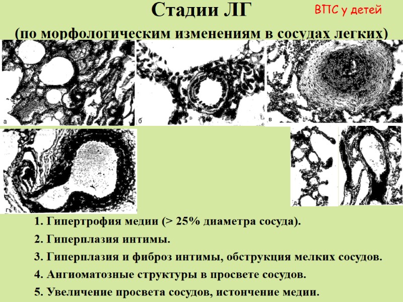 Стадии ЛГ  (по морфологическим изменениям в сосудах легких)  1. Гипертрофия медии (>